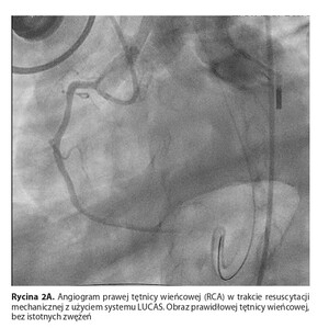 Figure from article: Sudden cardiac arrest due...